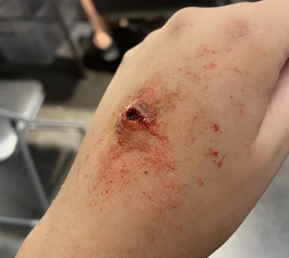 Fresh graze and puncture wound on the arm with blood trails