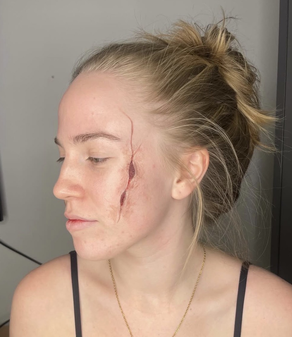 Fresh facial laceration running through the temple and cheekbone