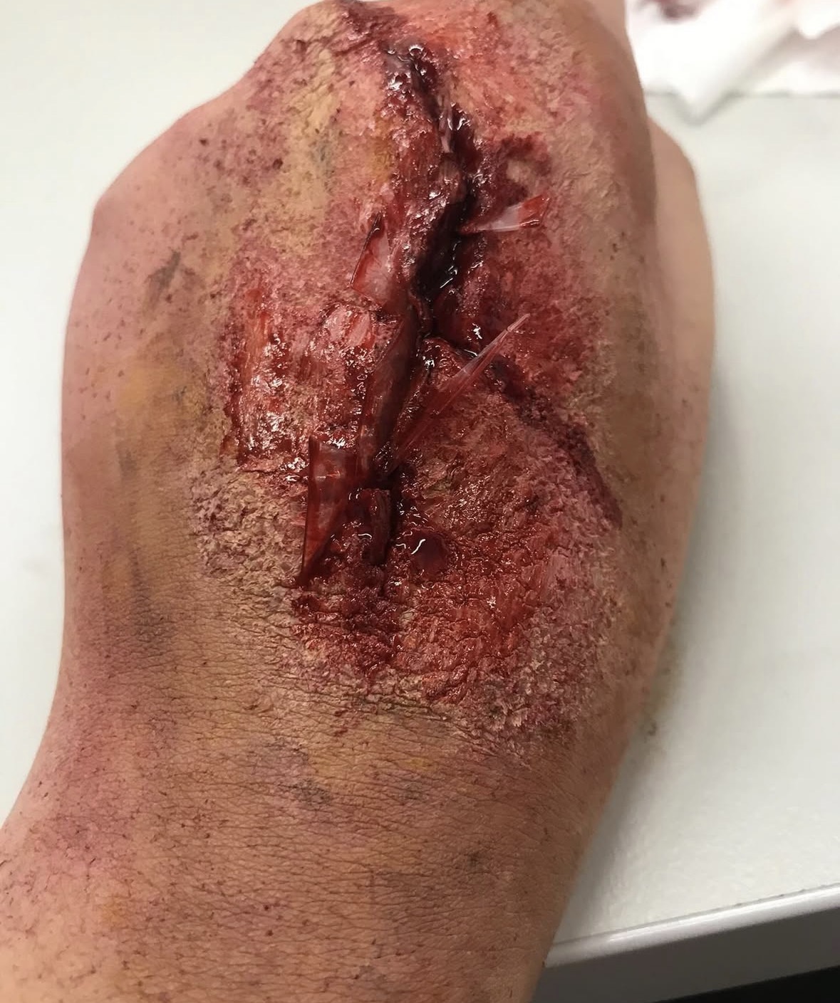 Deep gash wound with torn flesh and bruising on the forearm