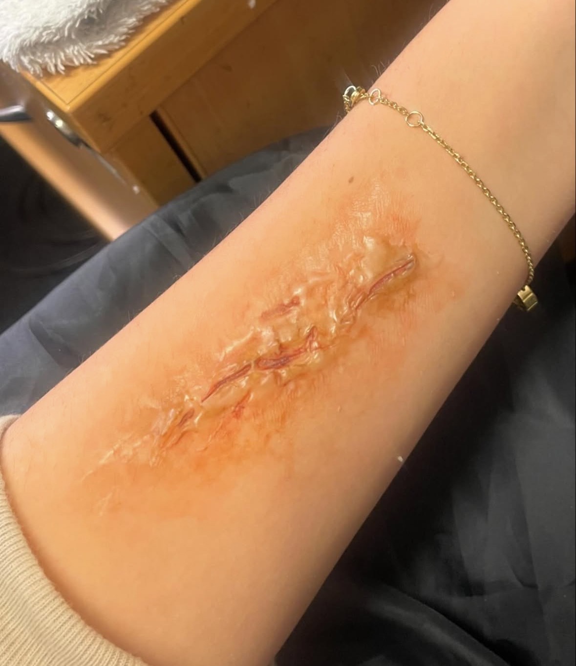 Healed burn-scar texture along the inner forearm