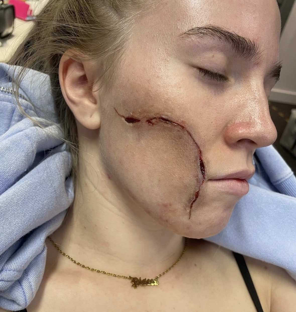 Sliced cheek and lip wound with fresh blood detail
