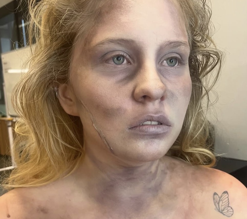 Strangulation bruising — ligature mark across the neck with pallor