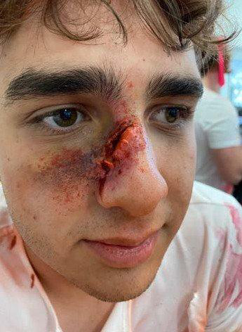 SFX bruise and laceration