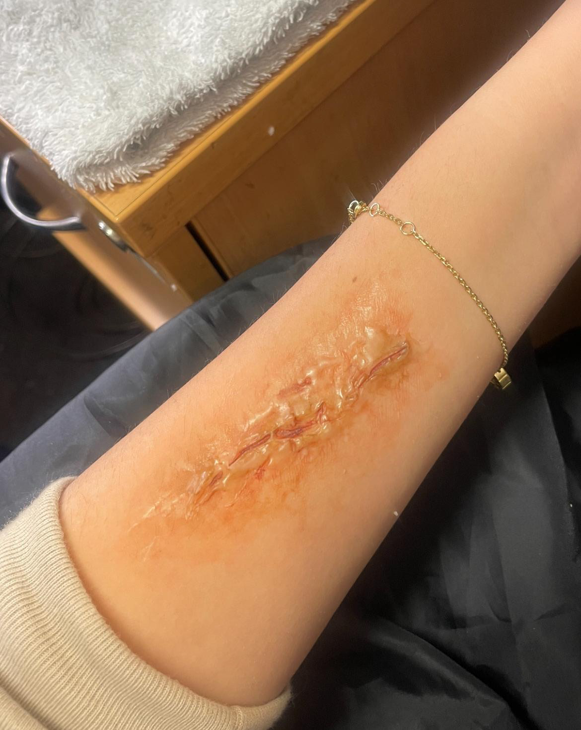 SFX wound study