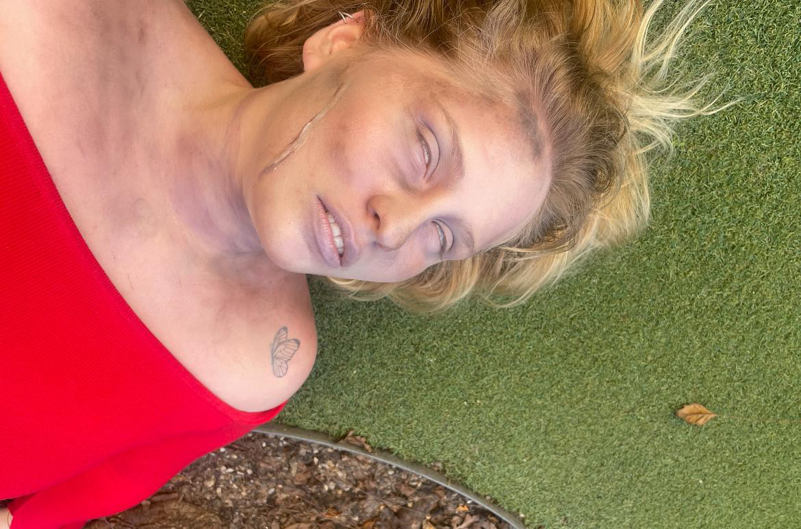 SFX injury close-up