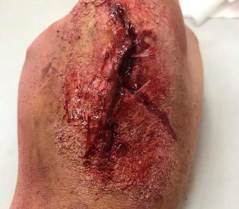 SFX wound study